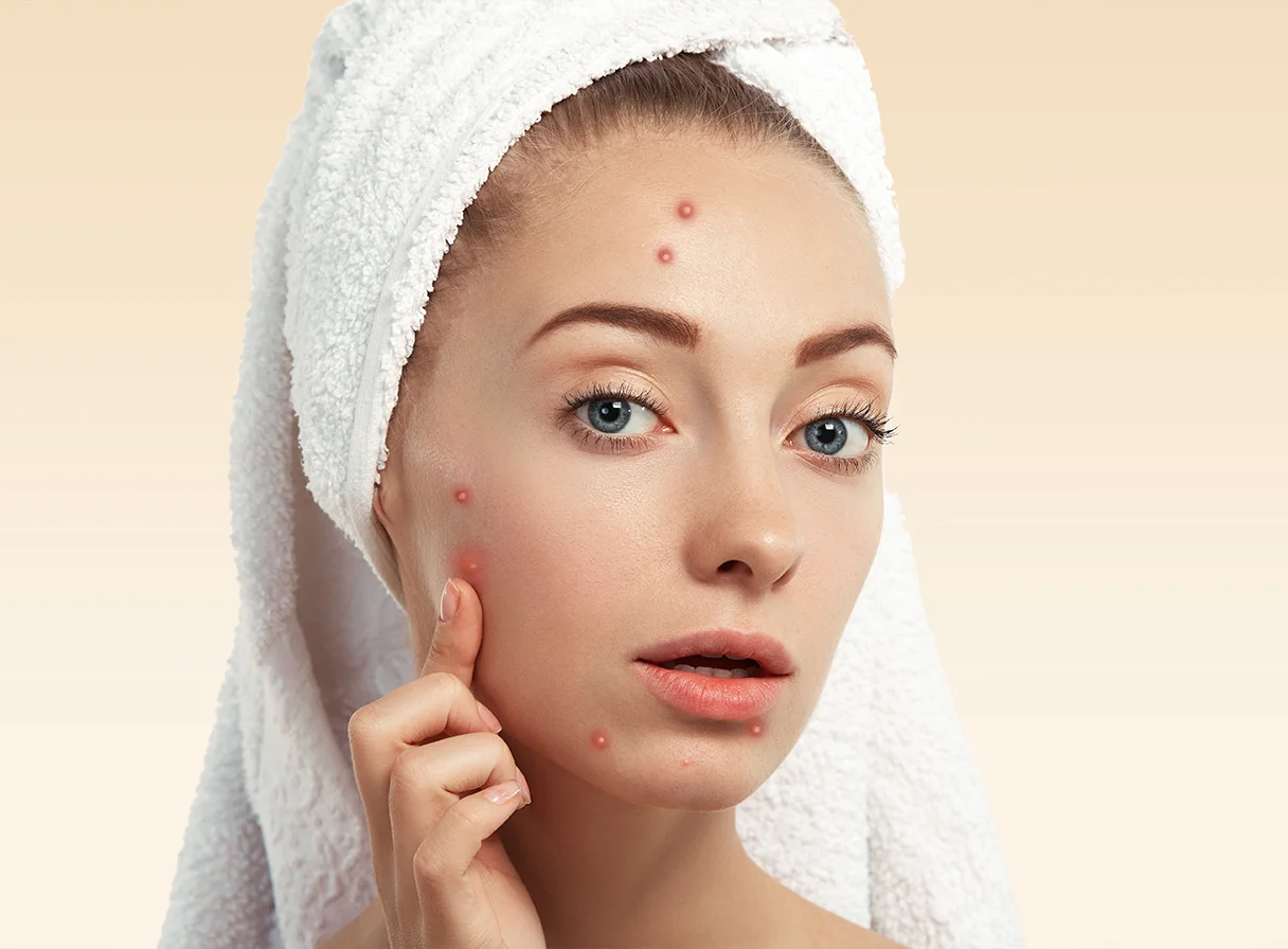 Acne and Skin Health Tips for Clear, Healthy Skin